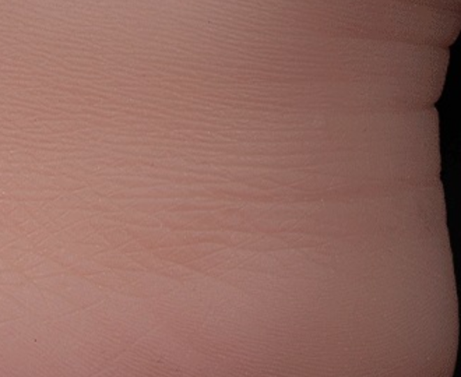 TPE: fine skin lines