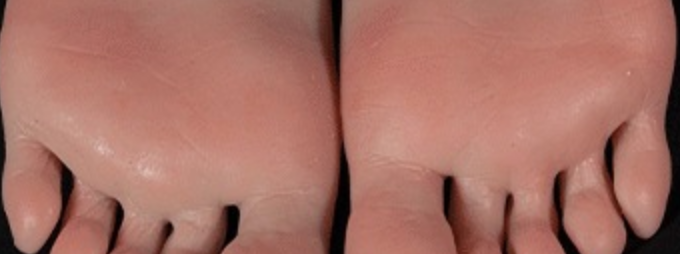 Platinum-cured silicone: sole and toe detail
