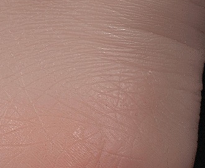Platinum-cured silicone: fine skin lines